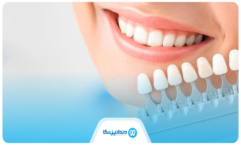 لمینت چیست ؟