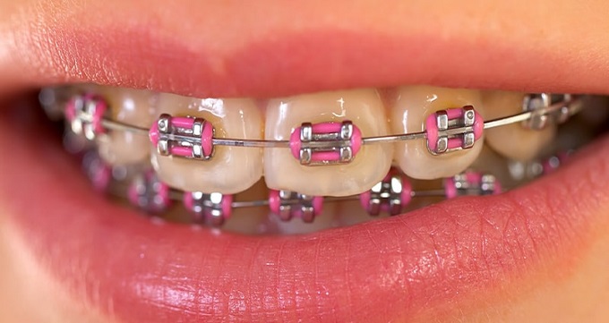  چه زمانی دندان ها نیاز به ارتودنسی دارند؟