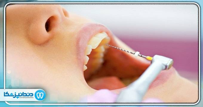 بهترین دندانپزشک درمان ریشه در تهران