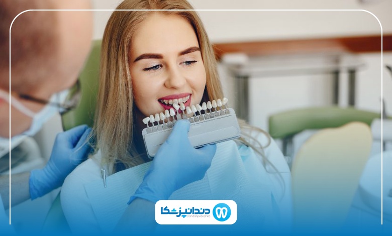 آشنایی با ونیر کامپوزیت در اصفهان