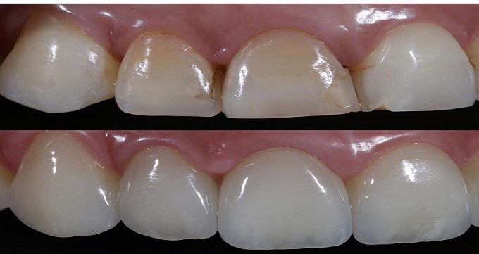 کامپوزیت دندان در چند نوع است؟
