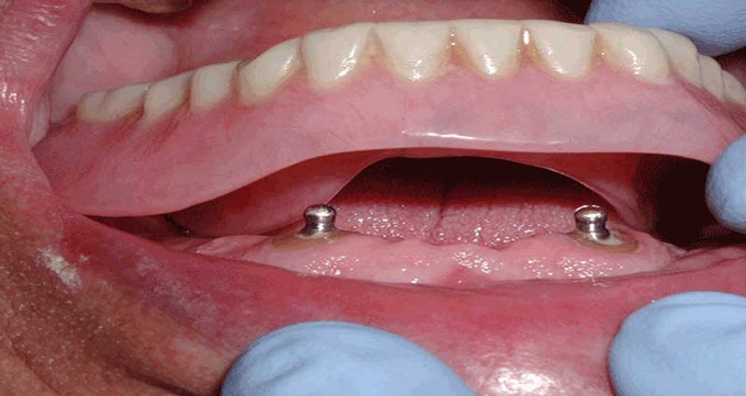 دسته بندی پروتزهای دندانی