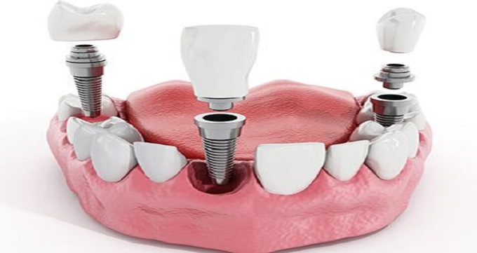 مزایای انجام ایمپلنت دندان