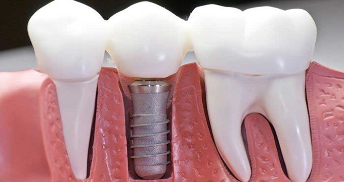 مزایای کاشت دندان به روش ایمپلنت