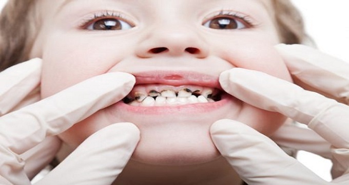 توصیه های پس از درمان دندانپزشکی کودکان