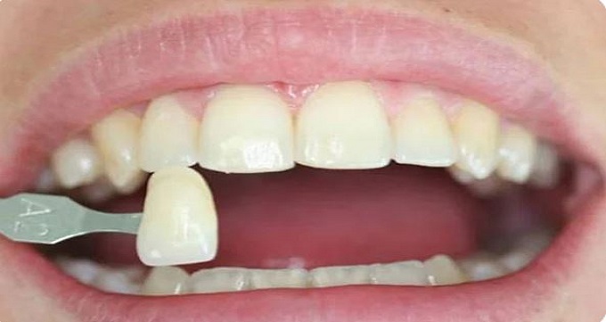 انواع کامپوزیت دندان براساس ماده سازنده