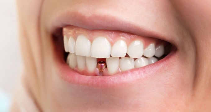 انواع روش های ایمپلنت دندان 