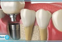 بهترین دکتر پروتز دندانی در ایران