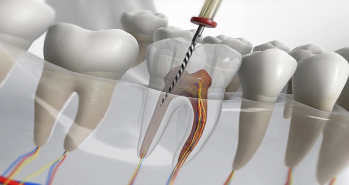 چه زمانی باید برای درمان ریشه به دندانپزشک مراجعه کرد؟