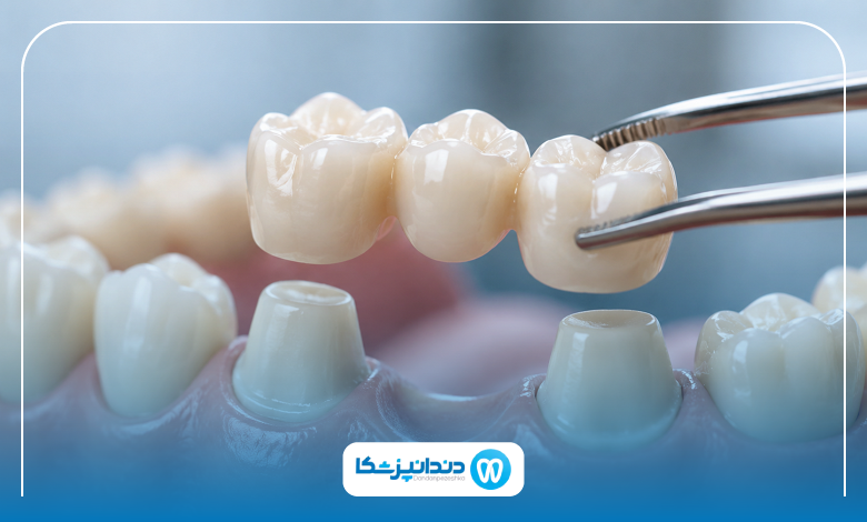 تفاوت بریج دندان با ایمپلنت