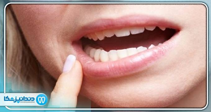 دندان لق چیست؟