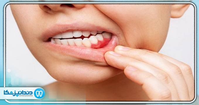 درمان فوری آبسه دندان و ورم صورت