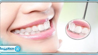 بهترین دکتر بلیچینگ در قیطریه