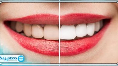 بهترین دکتر بلیچینگ در تجریش