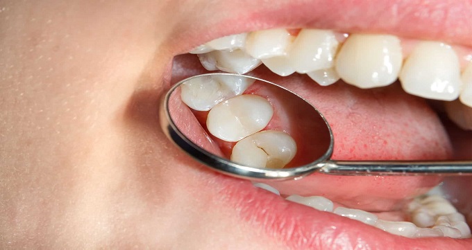 ترمیم دندان ها چگونه انجام می شوند؟