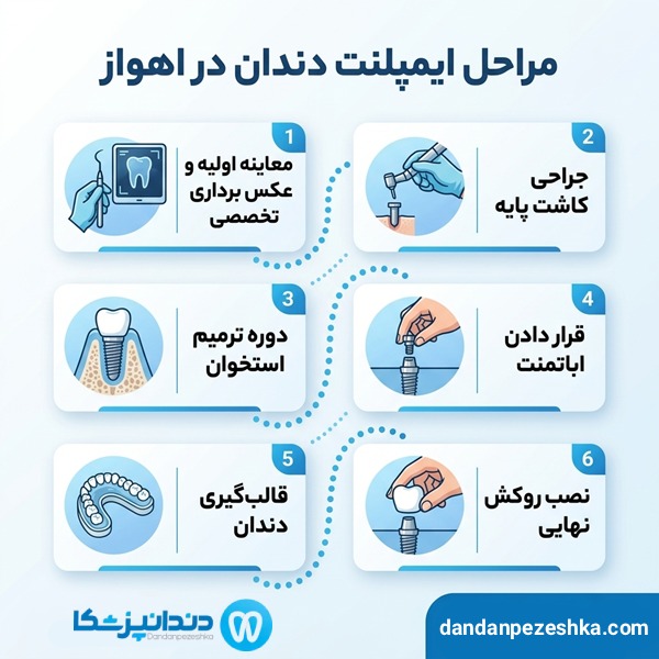 معیارهای انتخاب دکتر ایمپلنت خوب در اهواز