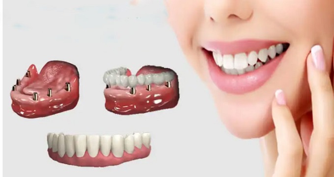 ایمپلنت دندان در چند نوع وجود دارد؟