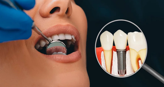 مزایا و معایب انجام ایمپلنت دندان