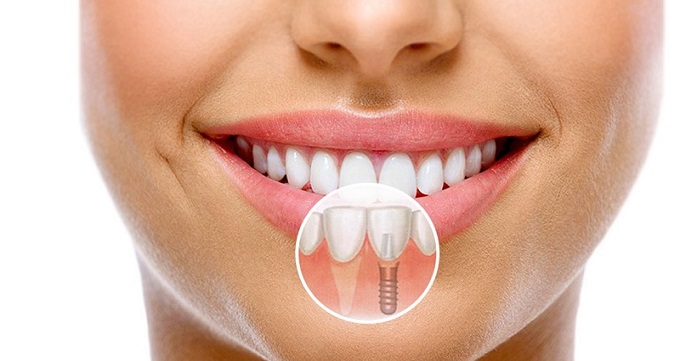 توصیه های بعد از انجام ایمپلنت دندان