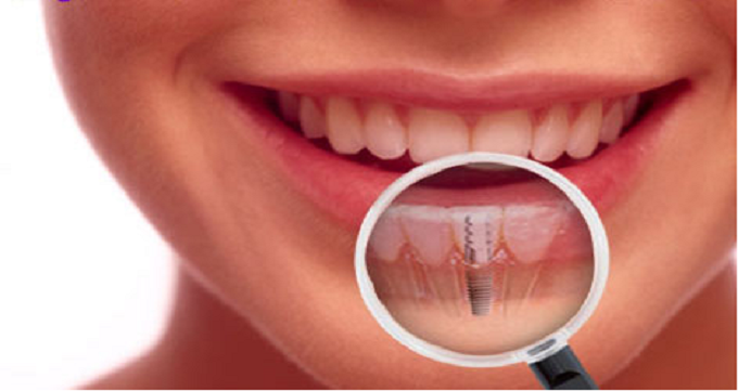 عوارض احتمالی انجام ایمپلنت دندان