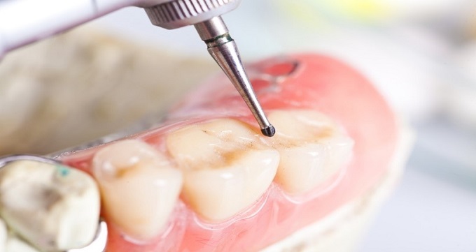 عصب کشی دندان و تفاوت آن با درمان ریشه