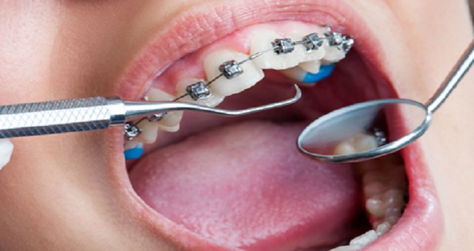 علت بی نظمی و به هم ریختگی دندان ها چیست؟