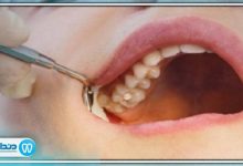 چرا کشیدن دندان عقل ضروری است؟