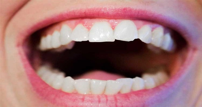 ترمیم دندان ها چگونه انجام می شود؟