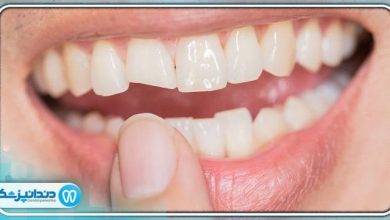 چگونه دندان شکسته شده را ترمیم کنیم؟