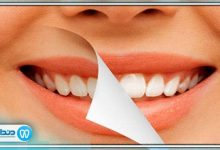 آیا جوش شیرین دندان ها را سفید می کند؟