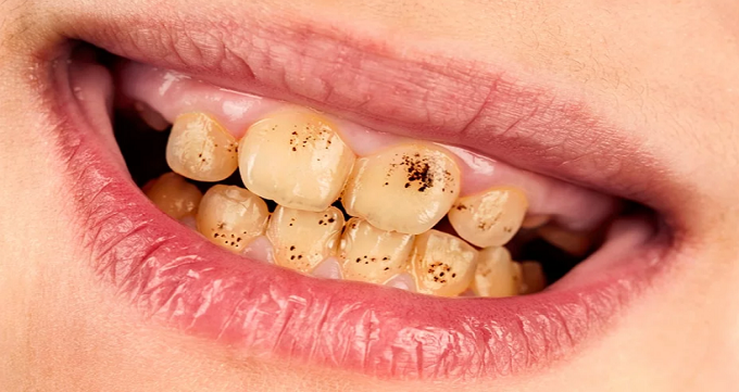 علل رنگ گرفتگی و کدری دندان ها چیست؟