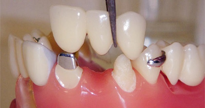 انواع بریج دندان