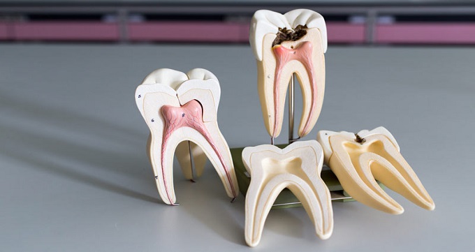 اگر دندان را عصب کشی نکنیم چه می شود؟