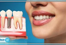 آیا ایمپلنت دندان دردناک است؟