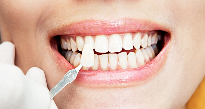 انواع لمینت دندان براساس مواد سازنده