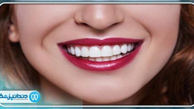 طول عمر کامپوزیت دندان چقدر است؟