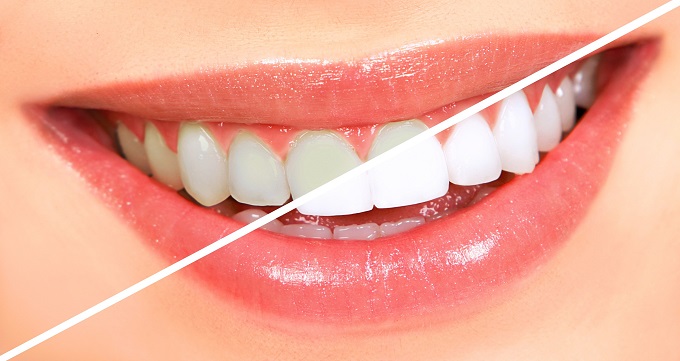 اقدامات کاهش دهنده طول عمر کامپوزیت دندان