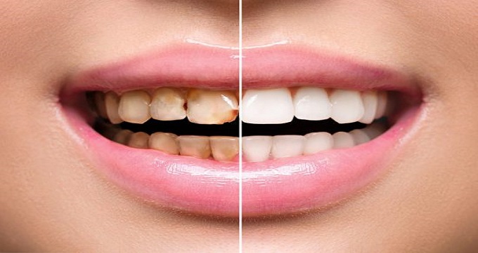 علل رنگ گرفتگی دندان ها چیست؟