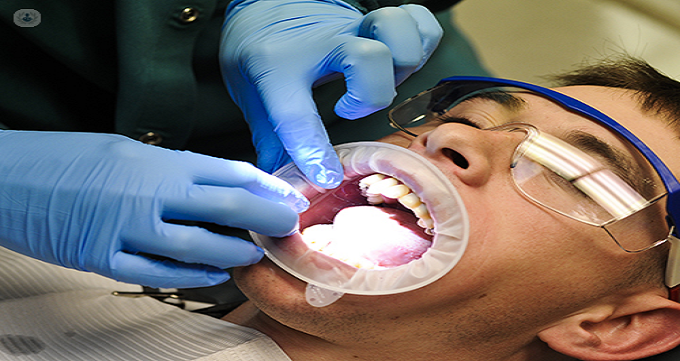 مراحل انجام بلیچینگ دندان