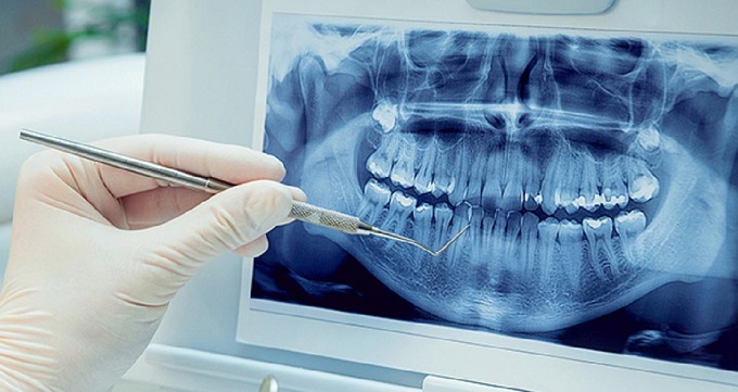 دلایل به عصب رسیدن دندان ها