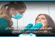 تفاوت های ایمپلنت دندان و بریج دندان