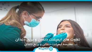 تفاوت های ایمپلنت دندان و بریج دندان