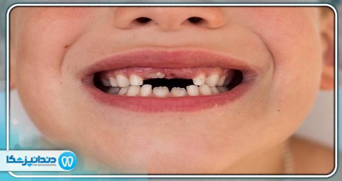 سریع  ترین راه درمان بی دندانی چیست؟