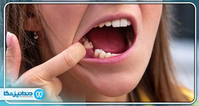 سریع  ترین راه درمان بی دندانی چیست؟