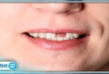 اگر دندان از دست رفته جایگزین نشود چه اتفاقی می افتد؟