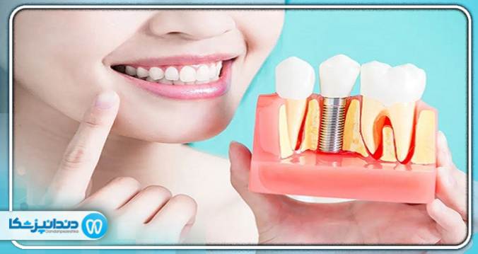 چرا به ایمپلنت دندان نیاز داریم؟