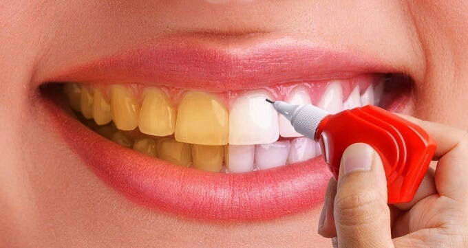 بلیچینگ دندان برای چه کسانی مناسب است؟