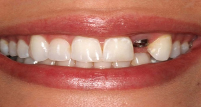 توصیه های مراقبتی بعد از ایمپلنت‌ دندان