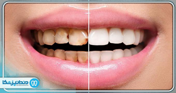 17 موردی که باعث خرابی دندان‌ ها می‌ شود
