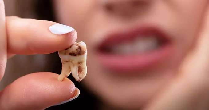 پوسیدگی و خرابی دندان چیست؟